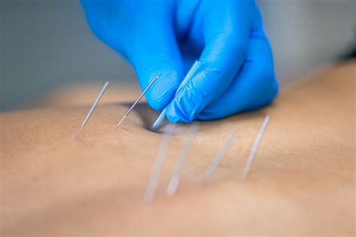 Can chiropractors practice acupuncture in Illinois?