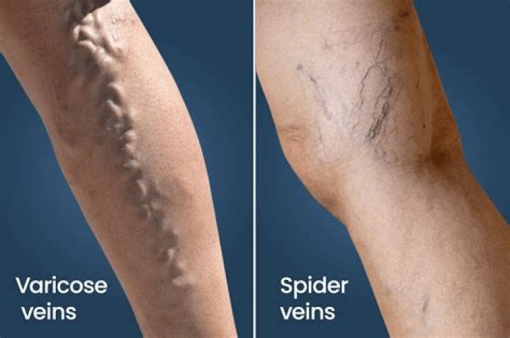 What causes varicose veins to form?
